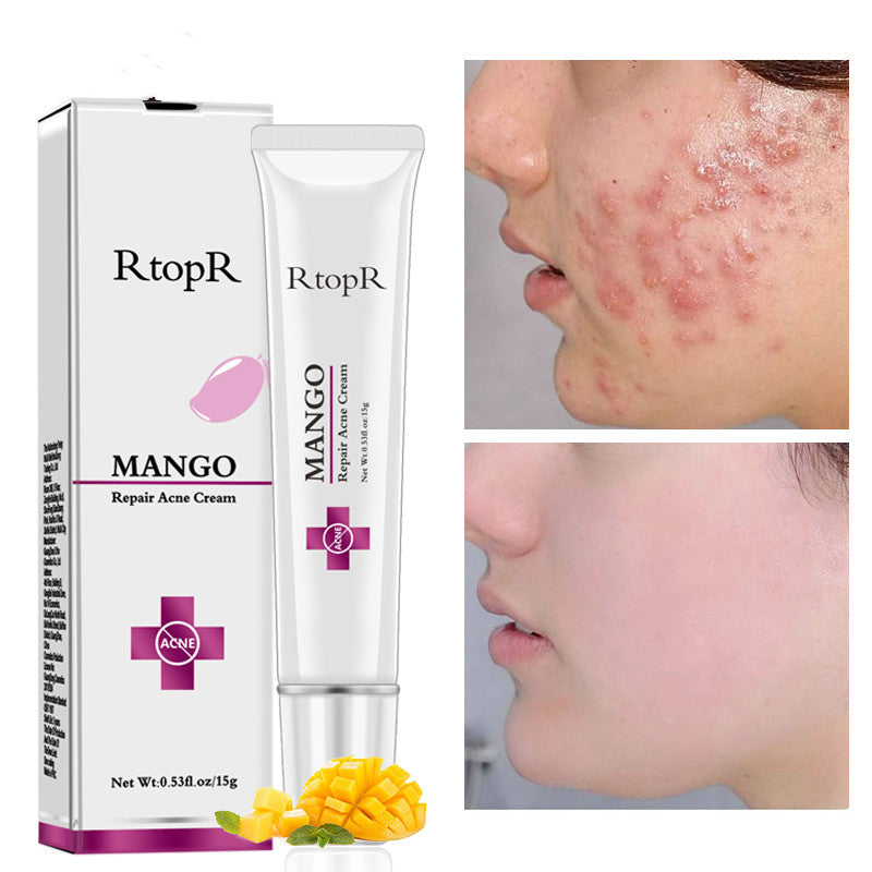 RtopR mango acne cream