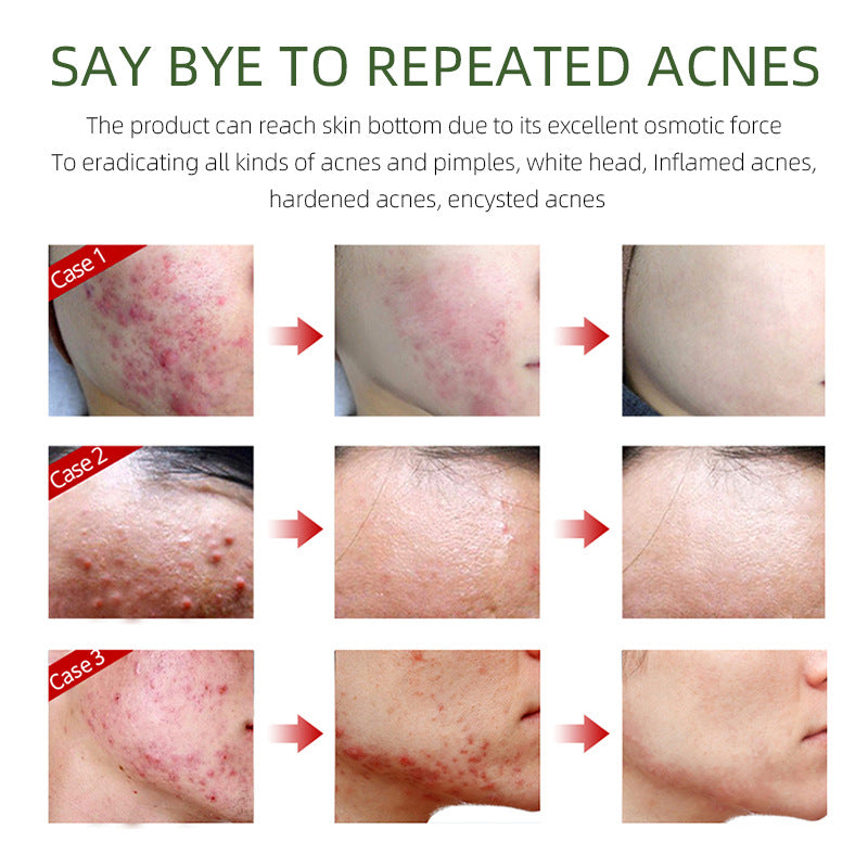 Herbal Acne Cream For Reducing Acne Marks